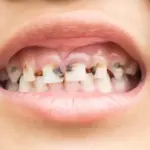 كيفية تنظيف التسوسات في المنزل؟